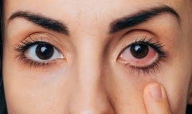 मानसून में तेजी से बढ़ रहा आई फ्लू (Eye Flu) का खतरा: जानें कंजंक्टिवाइटिस के लक्षण और बचाव के आसान उपाय